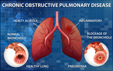 Lung with chronic obstructive pulmonary disease