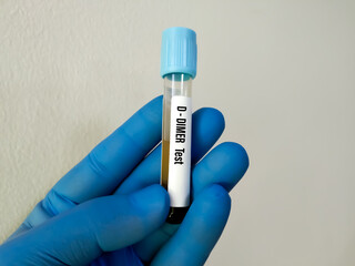 D-Dimer test. Corona patient monitoring test in ICU. Doctor or scientist hold a blood sample for...