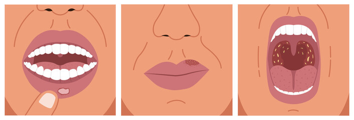 Canker sore, cold sore and sore throat. Vector illustration of aphthous ulcer, herpes and bacterial tonsillitis. - obrazy, fototapety, plakaty