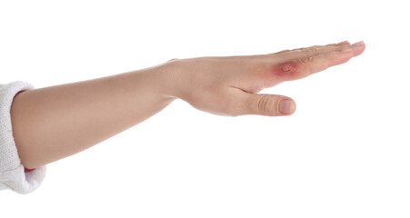 Woman with burn of her hand on white background, closeup