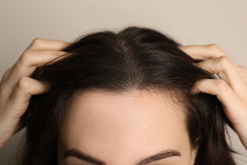 Fototapeta premium Woman suffering from baldness on grey background, closeup