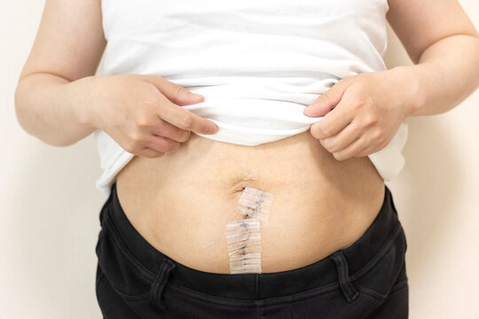 子宮筋腫で、お腹を切った手術の傷跡、手術後4週間（女性、日本人、30代）