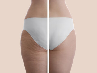 Collage with photos of woman before and after anti cellulite treatment on beige background, - obrazy, fototapety, plakaty