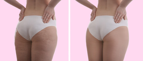 Collage with photos of woman before and after anti cellulite treatment on pink background, - obrazy, fototapety, plakaty