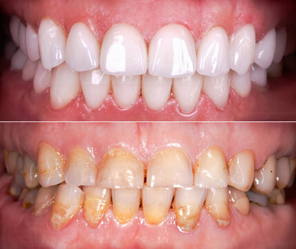 Perfect Smile Before And After Veneers Bleach Of Zircon Arch Ceramic Prothesis Implants Crowns. Dental Restoration Treatment Clinic Patient . Adult Old Woman Surgery Procedure Whitening Dentistry