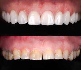 Perfect smile before and after veneers bleach of zircon arch ceramic prothesis Implants crowns....