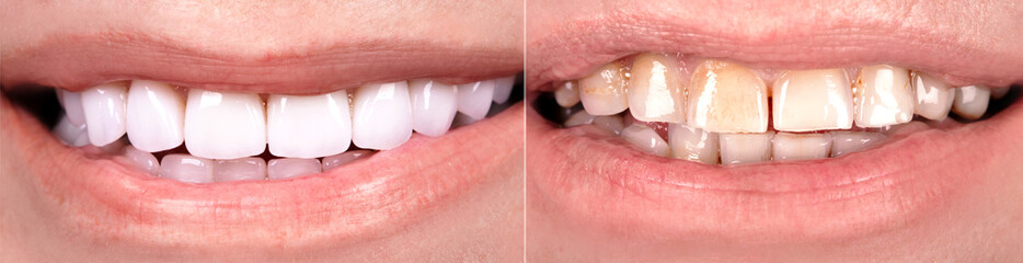 Perfect smile before and after veneers bleach of zircon arch ceramic prothesis Implants crowns....
