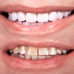 Perfect smile before and after veneers bleach of zircon arch ceramic prothesis Implants crowns. Dental restoration treatment clinic patient . Adult old woman surgery procedure whitening dentistry