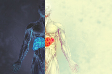Human liver disease. 3d illustration