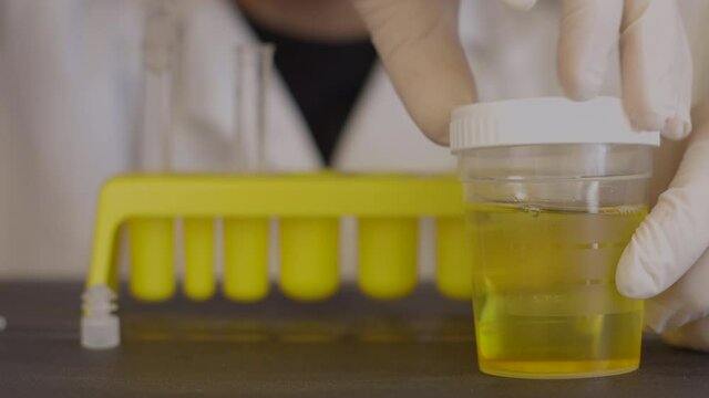 Doctor prepares urine specimen for analysis. Closeup view. Yellow liquid sample