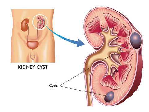 Medical Illustration Of A Kidney With Some Cysts.