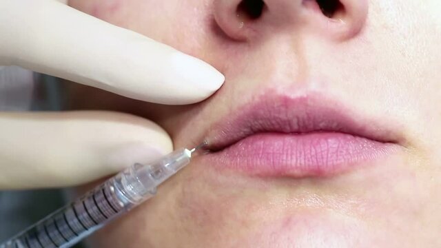 Lip augmentation hyaluronic acid filler injection real procedure in a professional cosmetology clinic. Upper lip. Video footage. Woman having lips plastic surgery operation procedure