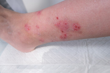 close-up of human shin, numerous wounds on leg of an adult female patient, redness, scarring, sores from scratching, concept of medical care, self-harm to skin