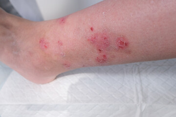 Naklejka premium close-up of human shin, numerous wounds on leg of an adult female patient, redness, scarring, sores from scratching, concept of medical care, self-harm to skin