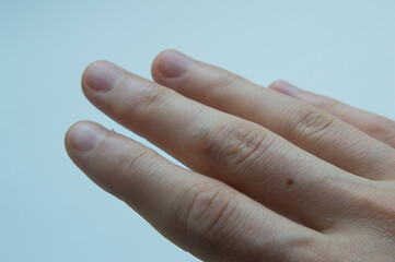 close-up: human right hand with second degree blister of skin burn on the middle finger