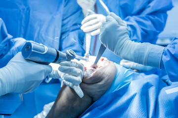 Selective focus with blurred background.Orthopedic surgeon in blue surgical gown suite using saw to cut the bone while total knee replacement surgery in osteoarthritis patient.Team of surgeons. - obrazy, fototapety, plakaty