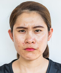 Unhappy Asian woman having problems of oily skin and acne inflamed on her face.