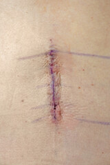 Along the spine, a four inch incision site is shown the day after a lumbar back operation at a hospital.