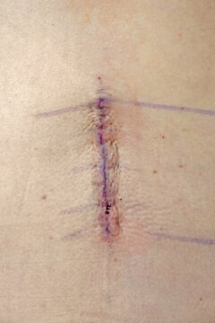 Along the spine, a four inch incision site is shown the day after a lumbar back operation at a hospital.
