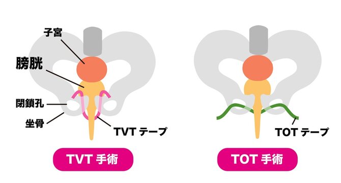 尿漏れ　TVT手術とTOT手術のメディカルイラスト素材