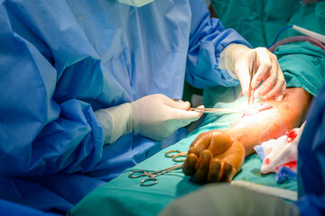 Orthopedic doctor and assistant team are preparing tools for arm bone surgery in hospital operating...