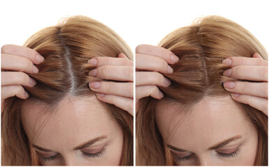 Woman suffering from baldness on white background, closeup. Collage with photos before and after treatment