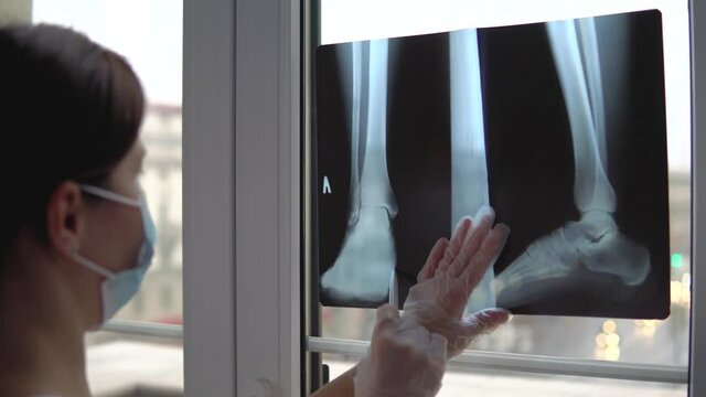 Doctor examines x-ray film of broken leg