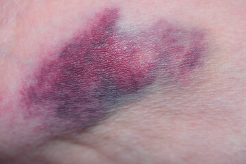 bruise on a woman's hand