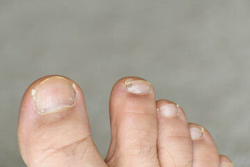 Man foot toes closeup with nail damage. Ugly feet