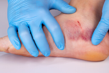 Doctor is examining an injured foot with bruise and scratch. Bruise on womans leg skin