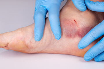 Doctor is examining an injured foot with bruise and scratch. Bruise on womans leg skin