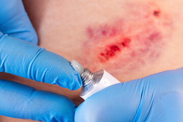 Doctors hands in gloves performs the treatment the wound with the help of ointment. Hematoma of...