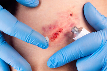 Doctors hands in gloves performs the treatment the wound with the help of ointment. Hematoma of...