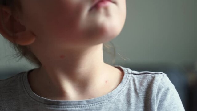 Toddler girl with chickenpox acne on her face. measles poxes on baby body. Viral childhood virus disease . Herpes illness, itch, fever symptopms