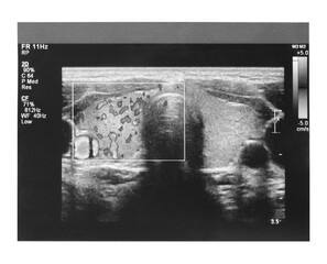 Ultrasound imaging of thyroid gland