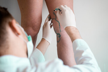 Vein markup. Vascular surgeon is marking veins for varicose surgery