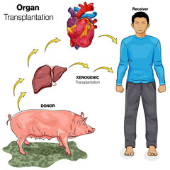 illustration of xenogeneic or xenograft organ transplantation from Pig to Human.  