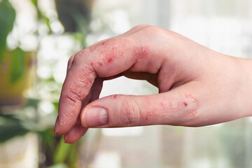 Psoriasis of the skin on a woman's hand. Peeling, rashes and cracks in the patient's skin. Chronic...
