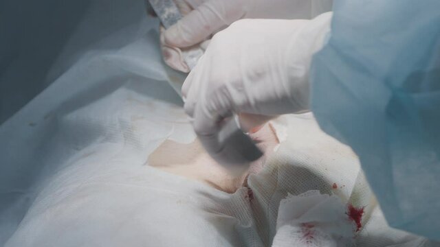 Surgical Laser Scalpel. Action. Neat incisions with laser scalpel. Surgeon cuts and cauterizes tissue with laser scalpel. Manual laser scalpel for precise incisions in surgery