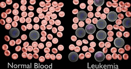 leukemia in 3d illustration