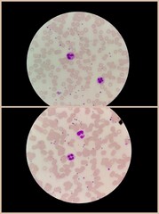 Blood smear of glass slide microscopic show clear view of two Neutrophil. Erythrocytes and...