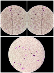 Blood smear of glass slide microscopic show Neutrophilic Leucocytosis. Erythrocytes and Platelets...