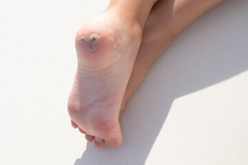 Group of warts on the patient's heel. White background. Macro. Closeup. Concept for treatment of viral warts in children, hygiene, human skin disease. Copy space. - obrazy, fototapety, plakaty