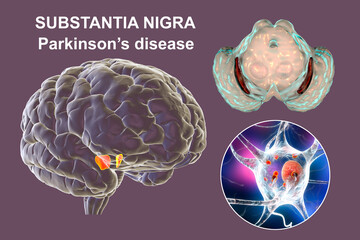 Substantia nigra, a basal banglia of the midbrain, in Parkinson's disease - obrazy, fototapety, plakaty