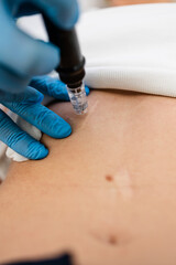 Beautiful young blonde woman receiving scar, mole or birthmark removal treatment at beauty clinic....
