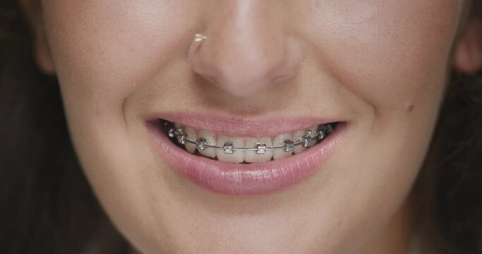 Teeth braces. Dental care. Orthodontic treatment. Close up of smiling young female with sincere beautiful smile