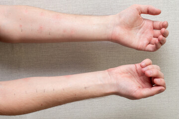 Hands with positive allergy tests. Allergy tests on the arms.