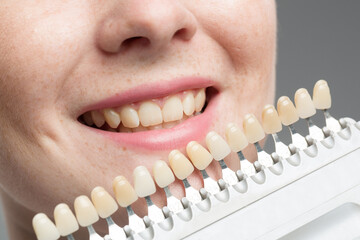 Close up of dentist using shade guide at woman's mouth to check veneer of teeth for bleaching 