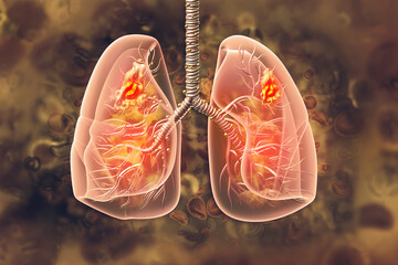 Lung cancer. lung disease. 3d illustration