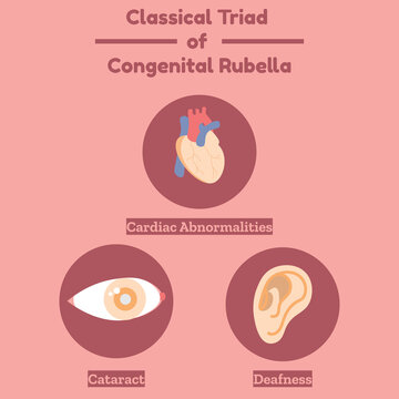 Classical Triad of Congenital Rubella